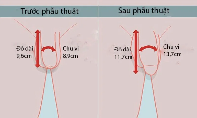 Chi phí phẫu thuật tăng kích thước cậu nhỏ bao nhiêu? Có đắt không? | 99 Men Clinic